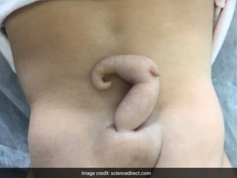 Brazilyada 6-sm uzunluğunda quyruğu olan qız uşağı dünyaya gəlib