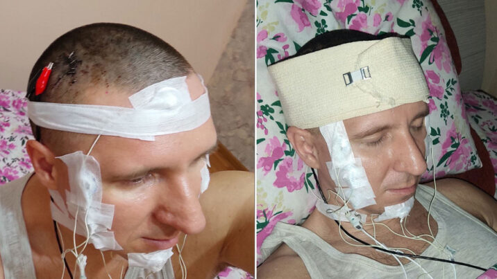 Başını burğu ilə deşib beyninə çip yerləşdirdi…