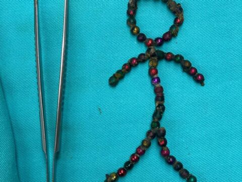 Azərbaycanda dəhşət: 4 yaşlı uşaq 53 ədəd maqnit uddu