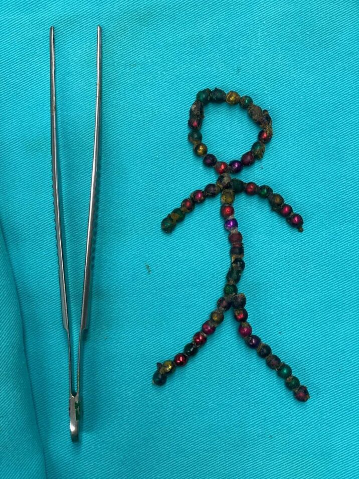 Azərbaycanda dəhşət: 4 yaşlı uşaq 53 ədəd maqnit uddu