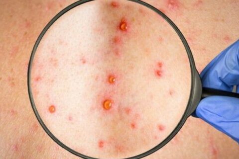 Ötən ilin 11 ayında Azərbaycanda neçə nəfər qızılcaya yoluxub?