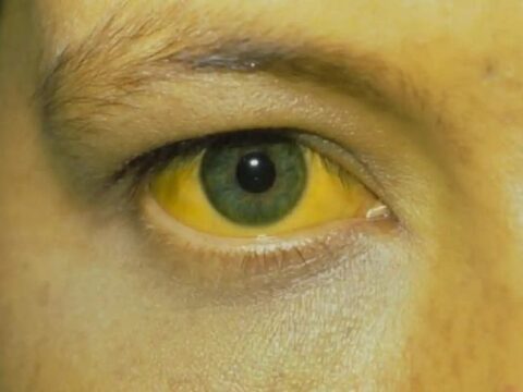 Bakıda sarılıq təhlükəsi: İki qəsəbədən 14 nəfər xəstəxanada