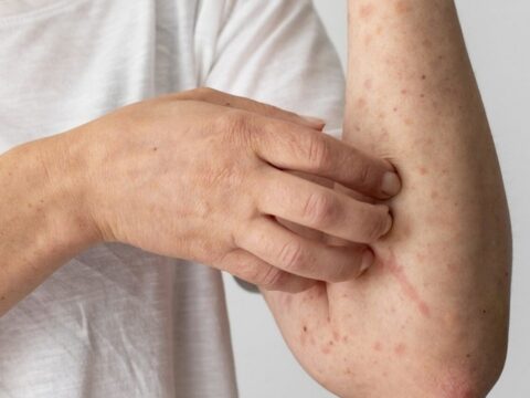 Azərbaycanda 3 xəstəlik tüğyan edir: Sarılıq, qızılca və göyöskürək…