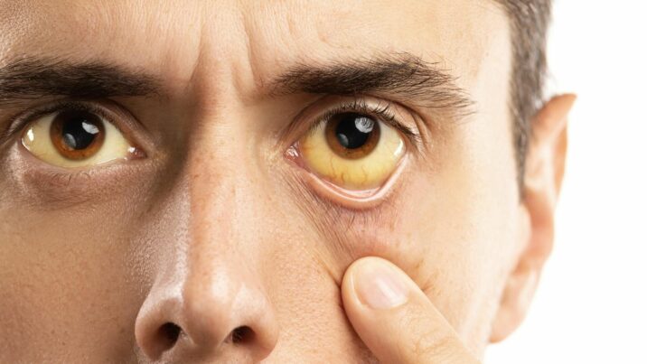 Azərbaycanda “Hepatit” təşvişi: Virus su ilə yayılır?