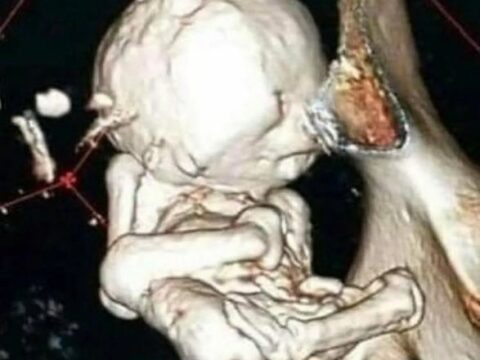 Ölü körpəsini 35 il bətnində gəzdirdi