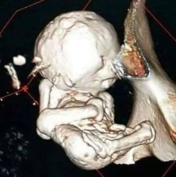 Ölü körpəsini 35 il bətnində gəzdirdi Ölü körpəsini 35 il bətnində gəzdirdi